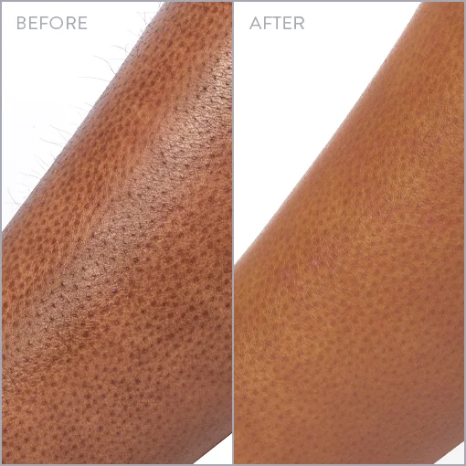Experts In Laser Hair Removal Milan Laser Location Clearwater FL