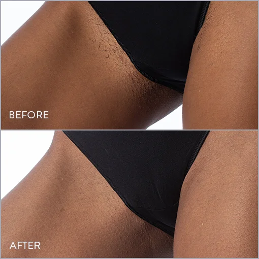 Bikini Laser Hair Removal Photo, Before & After